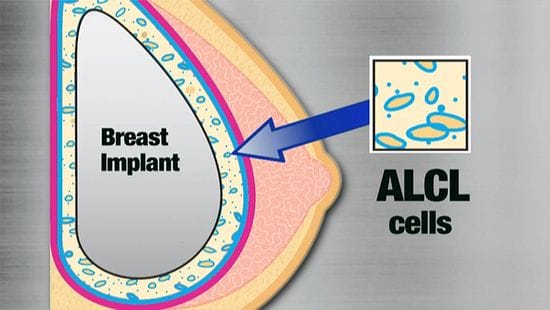 Breast Implant Related Anaplastic Large Cell Lymphoma